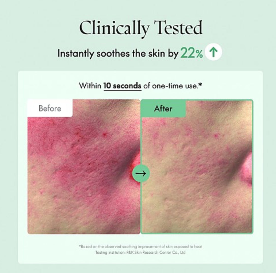 Acne Prone Skin care routine set
