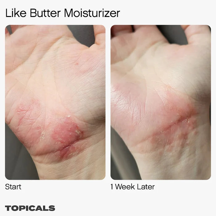 Topicals
Like Butter Moisturizer for Dry, Sensitive & Eczema-Prone Skin