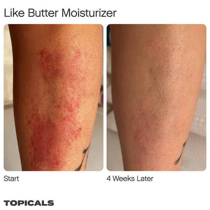 Topicals
Like Butter Moisturizer for Dry, Sensitive & Eczema-Prone Skin