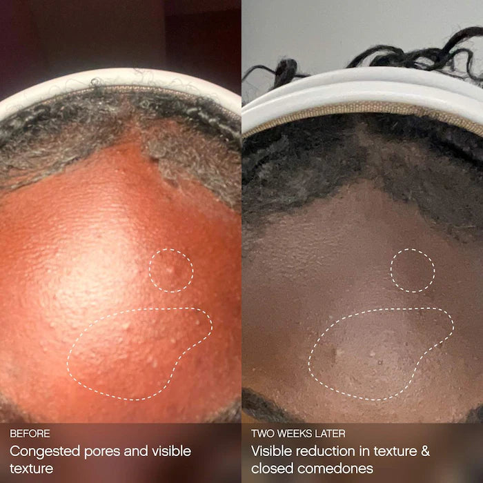 Topicals 
Clearly Clarifying & Calming Mist For Acne-Prone Skin