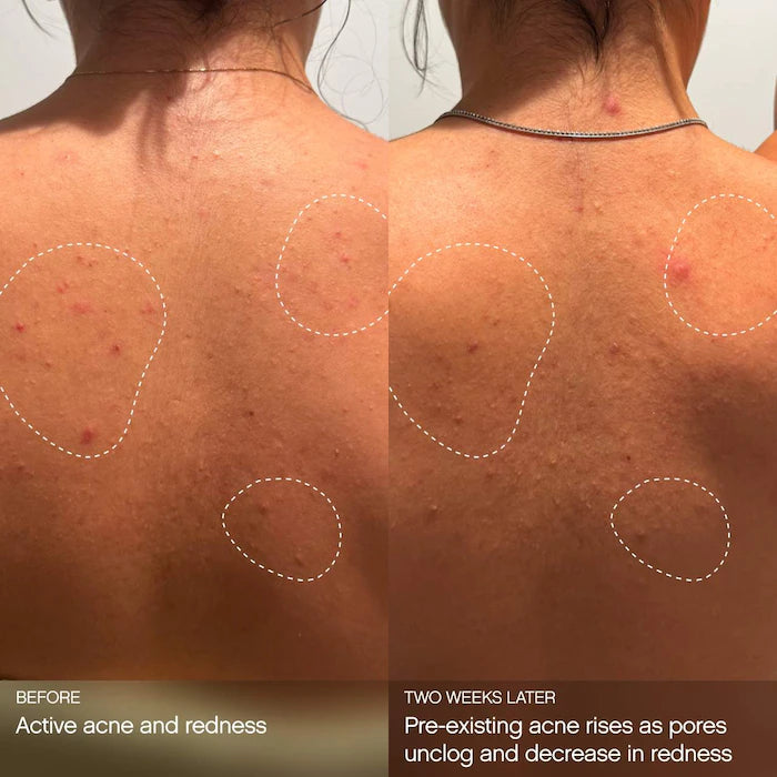 Topicals 
Clearly Clarifying & Calming Mist For Acne-Prone Skin