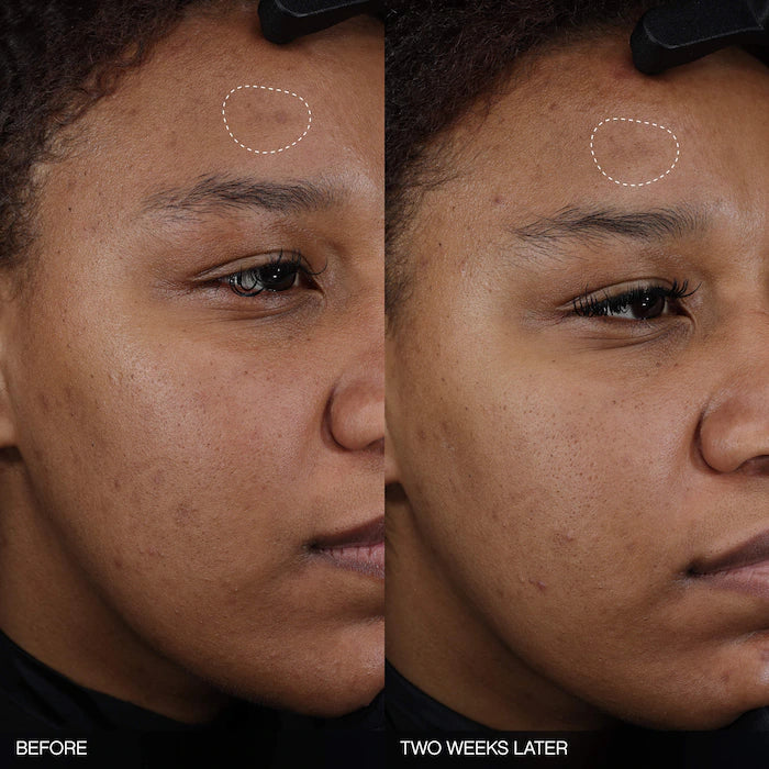 Topicals 
Faded Tranexamic Acid Dark Spot Patches for Hyperpigmentation 20 patches