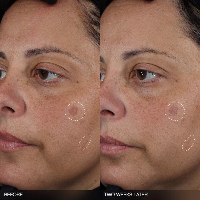 Topicals 
Faded Tranexamic Acid Dark Spot Patches for Hyperpigmentation 20 patches